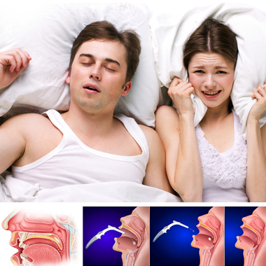 Ha horkolsz, vagy hallgatod: 2 kezeléses horkolást megszüntető műtét nélküli Somnoplasty terápiás eljárás, neves fül-orr-gégésztől.
