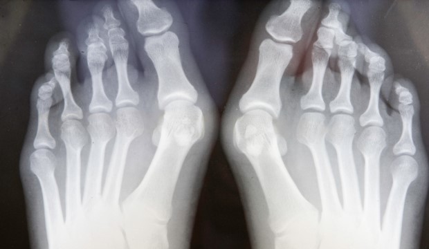 Miért fontos megelőzni a láb bütykeinek kialakulását?