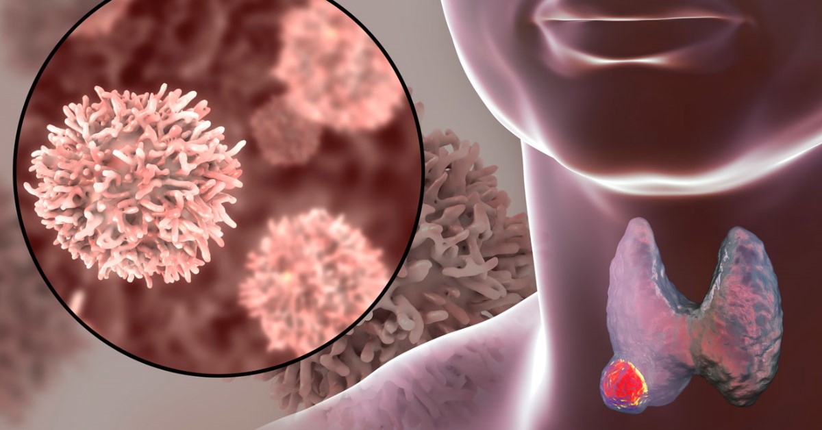 anaplasztikus rák humán papillomavírus hpv magas kockázatú típusok