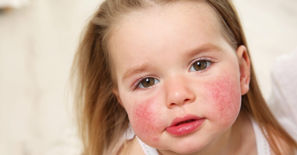 Allergizáló nyári gyümölcsök, ezek okozhatnak allergiát gyermekednél