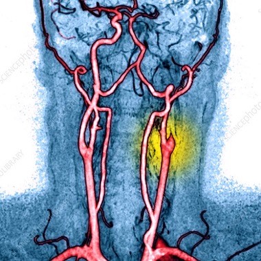 Nyaki erek color Doppler ultrahang vizsgálata radiológus szakorvossal a Benyovszky Orvosi Központban. Megelőzhető vele: Érelzáródás, stroke, ...