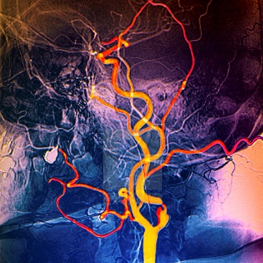 Nyaki erek color Doppler ultrahang vizsgálata radiológus szakorvossal a Benyovszky Orvosi Központban. Megelőzhető vele: Érelzáródás, stroke, ...