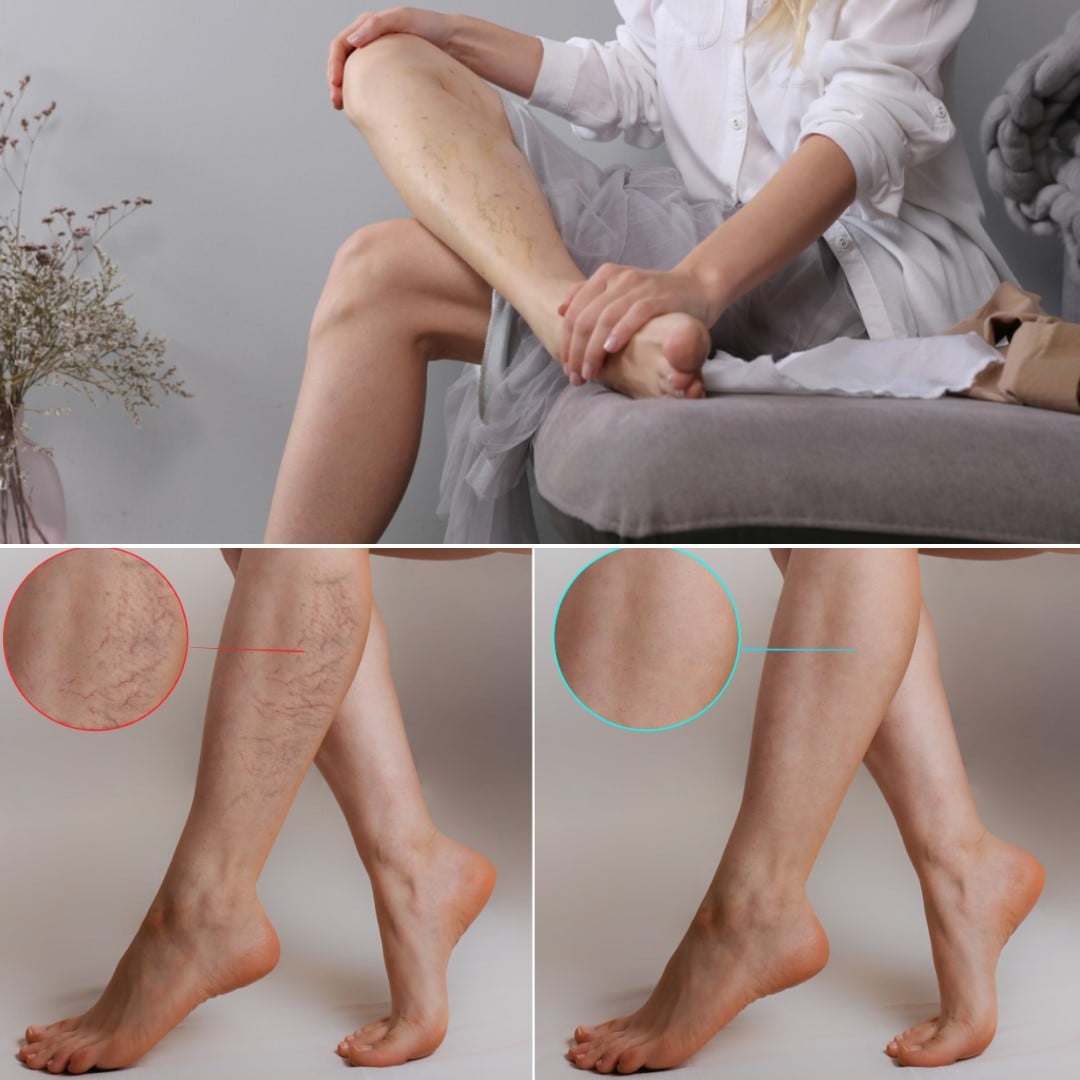 A láb újjászületéséért: Szkleroterápia, azaz ORVOSI visszértágulat eltüntető kezelés, konzultációval (súlyosabb esetben több kezelésre is szükség lehet)